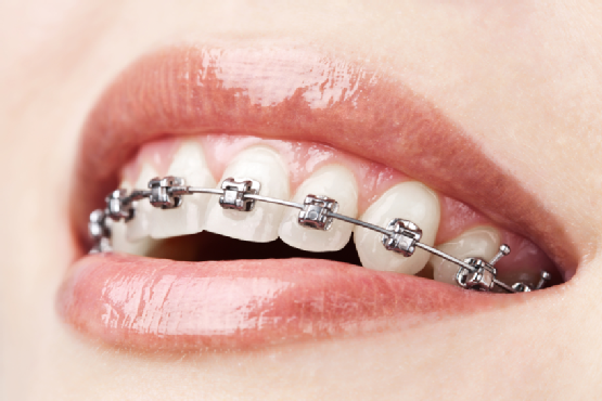 Elastics in orthodontics - Orthodontics in Summary