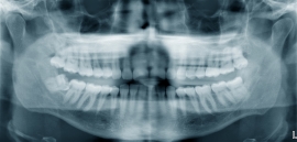 Dental X-rays In Chicago