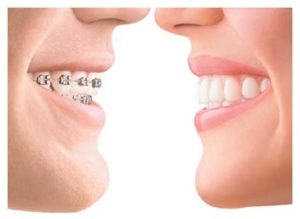 Invisalign Treatment Chicago, IL - Get Clear Aligners In South Loop