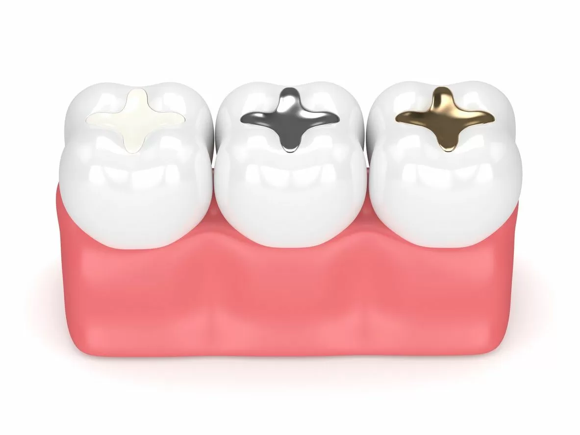 How Much Does a Dental Filling Cost? - Explained